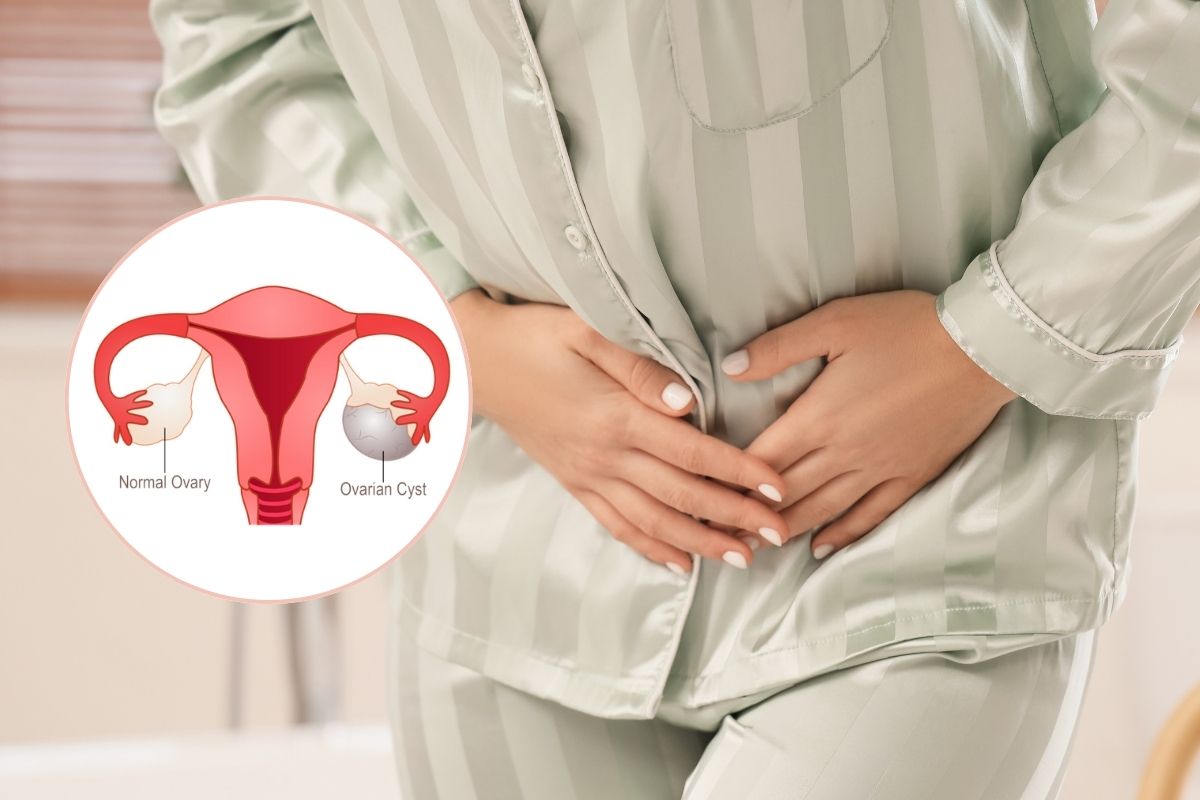 Ovarian-Cyst-Removal